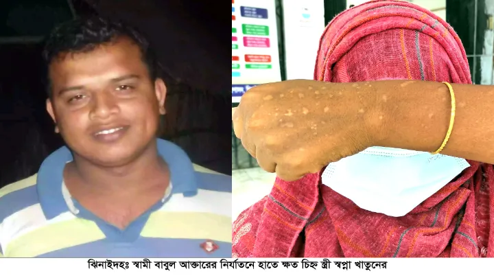 পরকীয়ায় সুখের সংসার তছনছ স্ত্রীর শরীরে নির্যাতনের চিহ্ন