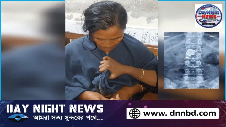 রোগী সেজে সোনার চেইন চুরি, এক্সরে করে পেটে শনাক্ত